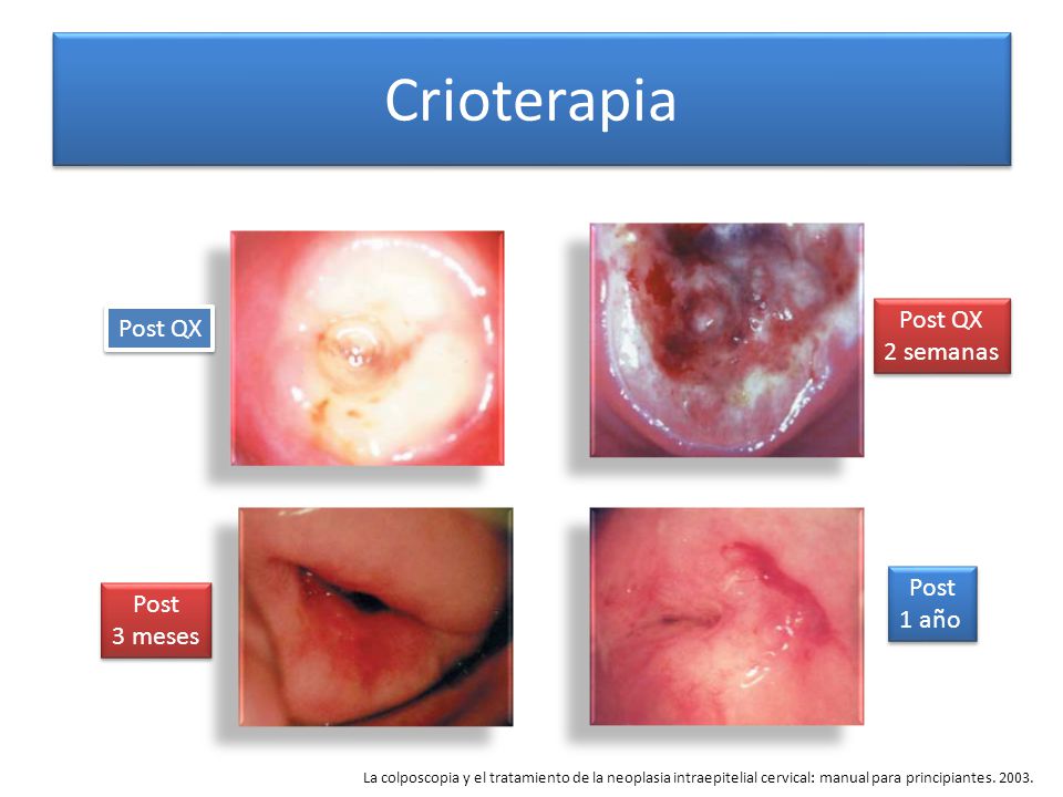 crioterapia cervical